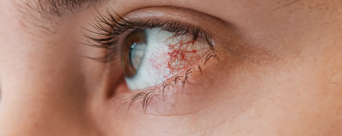Zdjęcie Uszkodzona rogówka oka objawy - poznaj niepokojące symptomy
