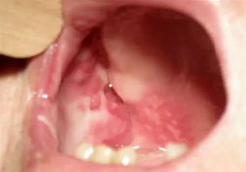 Zdjęcie Jakiego lekarza wybrać przy chorobach błony śluzowej jamy ustnej?