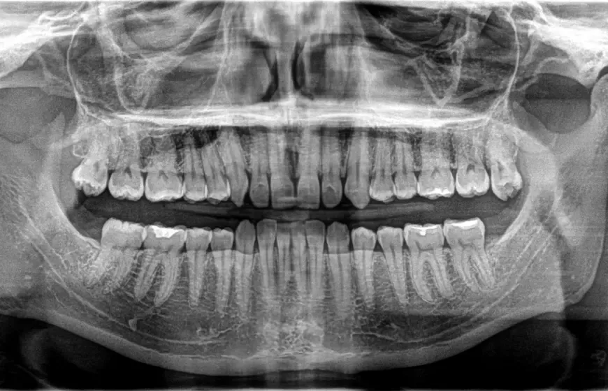 Zdjęcie RTG zęba: Co naprawdę widzi dentysta? Ukryta próchnica i torbiele