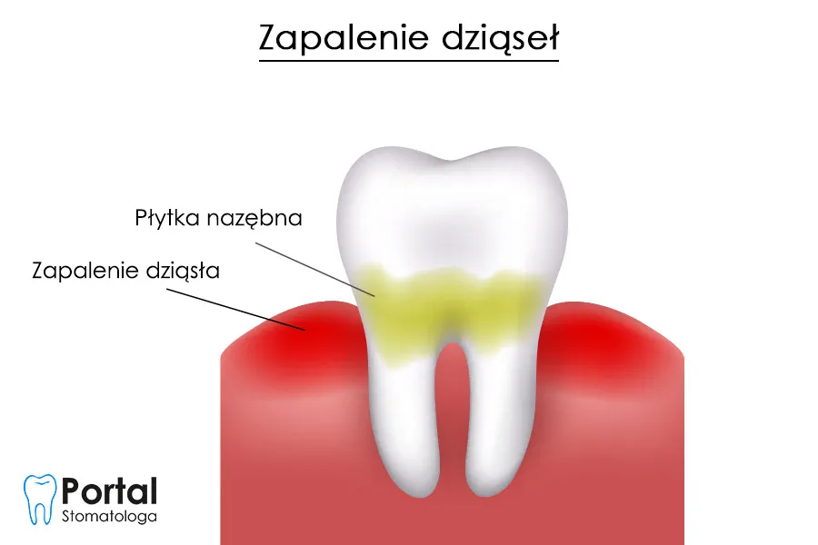 Zdjęcie Jak skutecznie leczyć zapalenie dziąseł – domowe sposoby i porady stomatologa