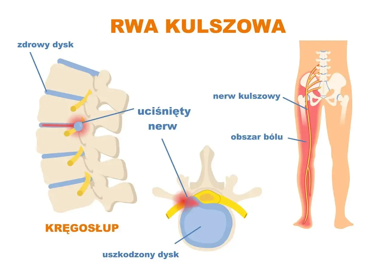 Zdjęcie Przyczyny rwy kulszowej: co może wywołać ten bolesny stan?