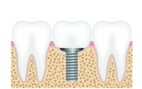Zdjęcie Ile po dentyście nie można jeść? Kluczowe informacje dla pacjentów