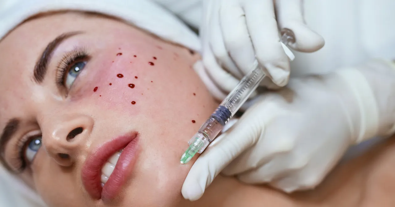 Zdjęcie Skutki uboczne wampirzego liftingu - co musisz wiedzieć przed zabiegiem