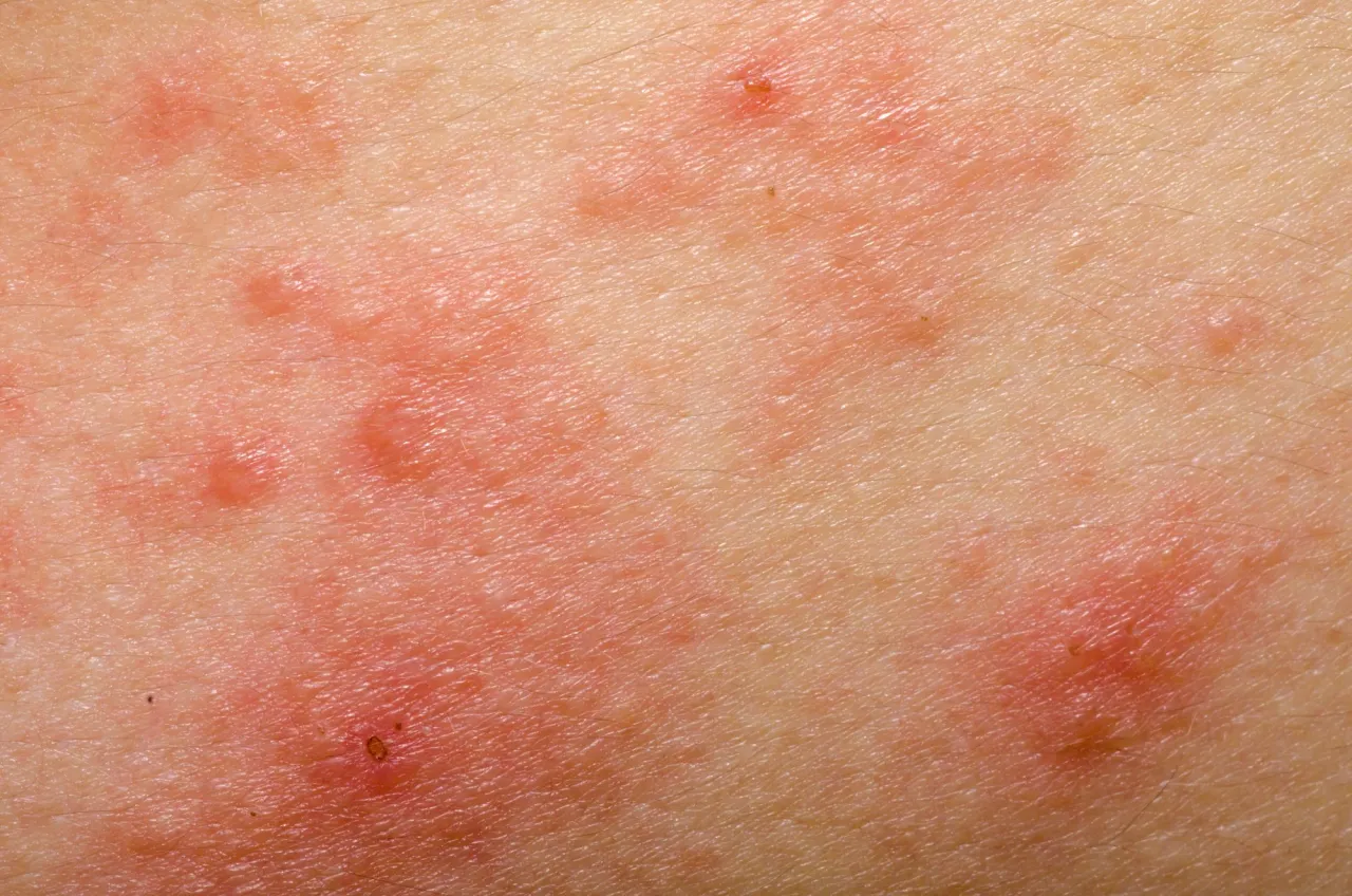 Zdjęcie Alergia na gluten objawy: jak rozpoznać niebezpieczne reakcje