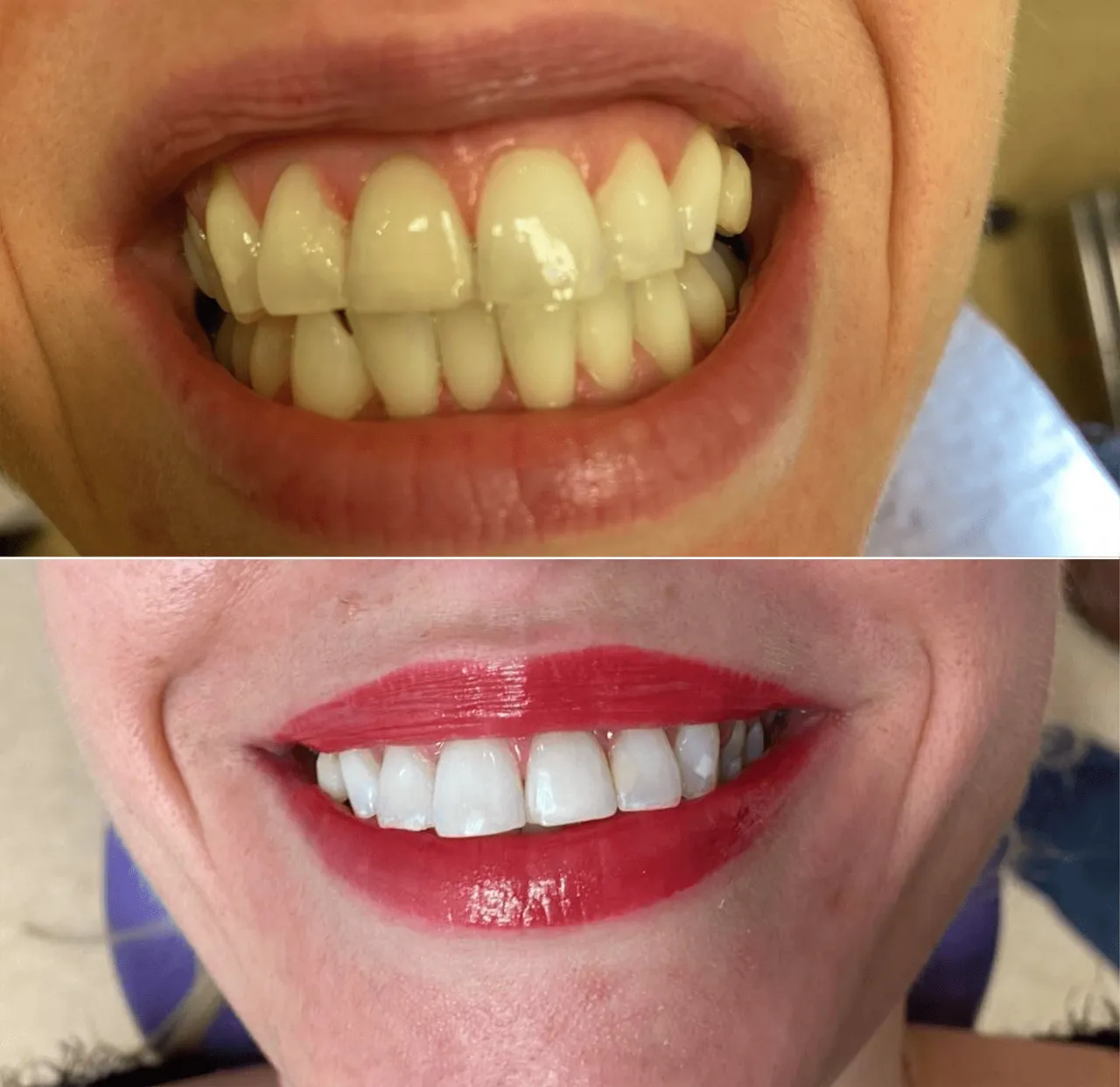 Zdjęcie Ile kosztuje wybielenie zębów u dentysty? Sprawdź ceny i metody