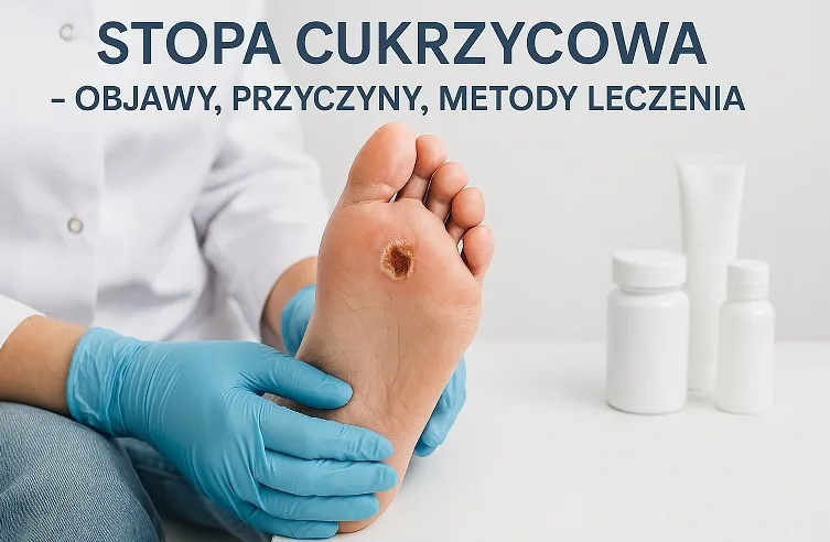 Zdjęcie Jak leczyć stopę cukrzycową - Skuteczne metody i porady dla zdrowia