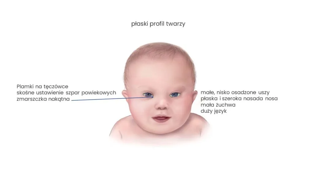 Zdjęcie Zespół Downa: objawy, diagnoza i życie z trisomią 21