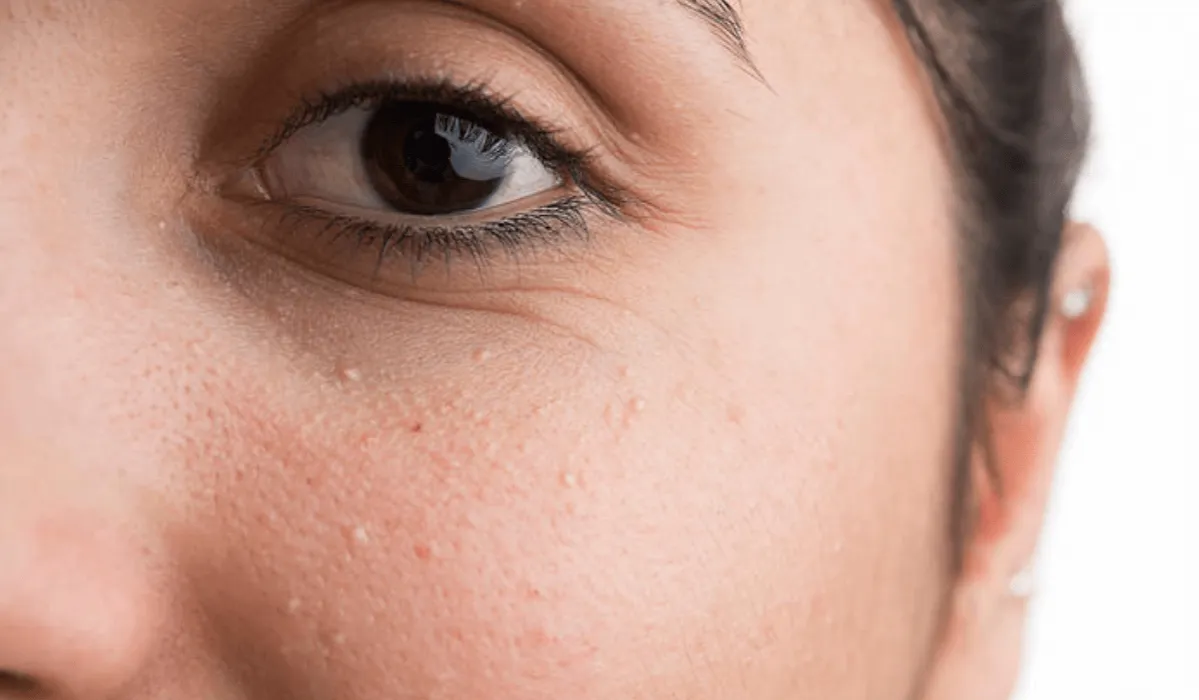 Zdjęcie Pryszcze na policzkach co oznaczają? Poznaj przyczyny i objawy