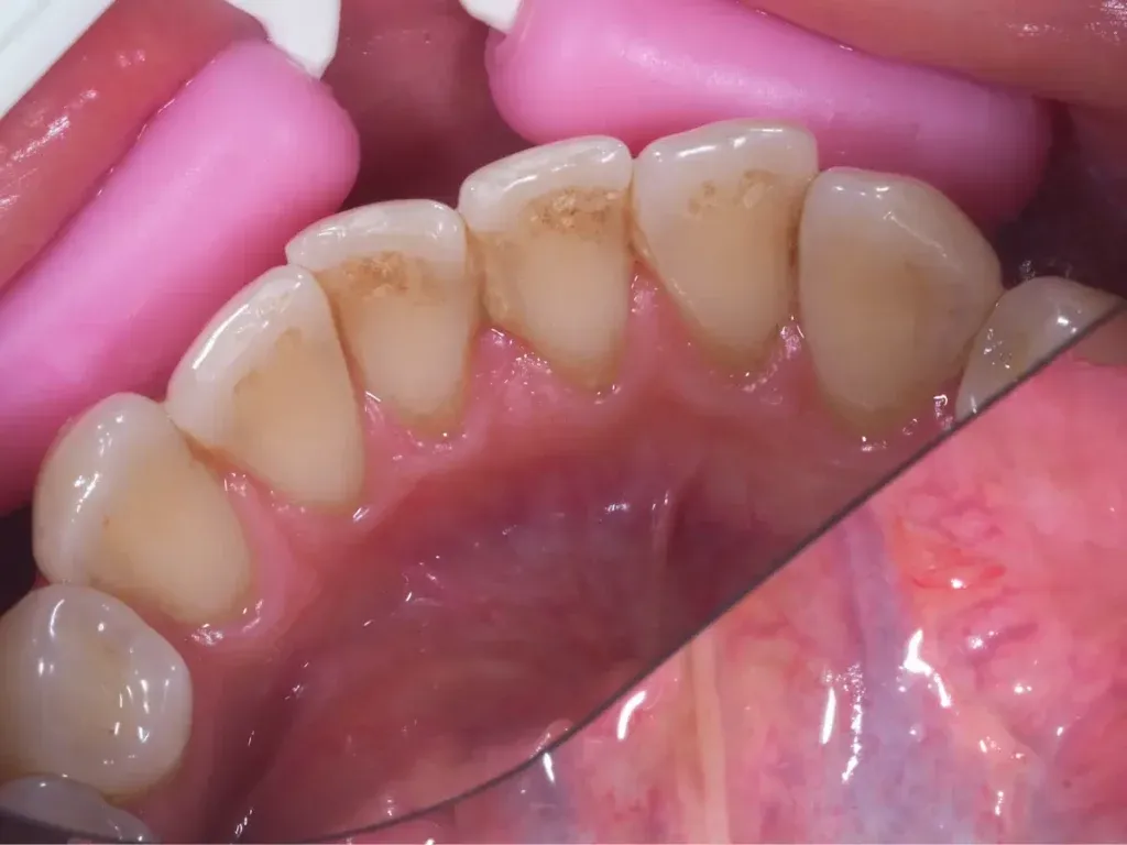 Zdjęcie Jak usunąć osad z zębów u dziecka i zadbać o ich zdrowie