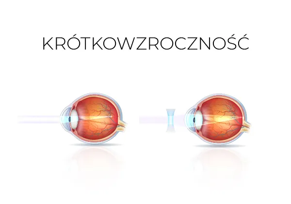 Zdjęcie Ostrość wzroku 0,2 ile to dioptrii? Zrozum swoją wadę wzroku