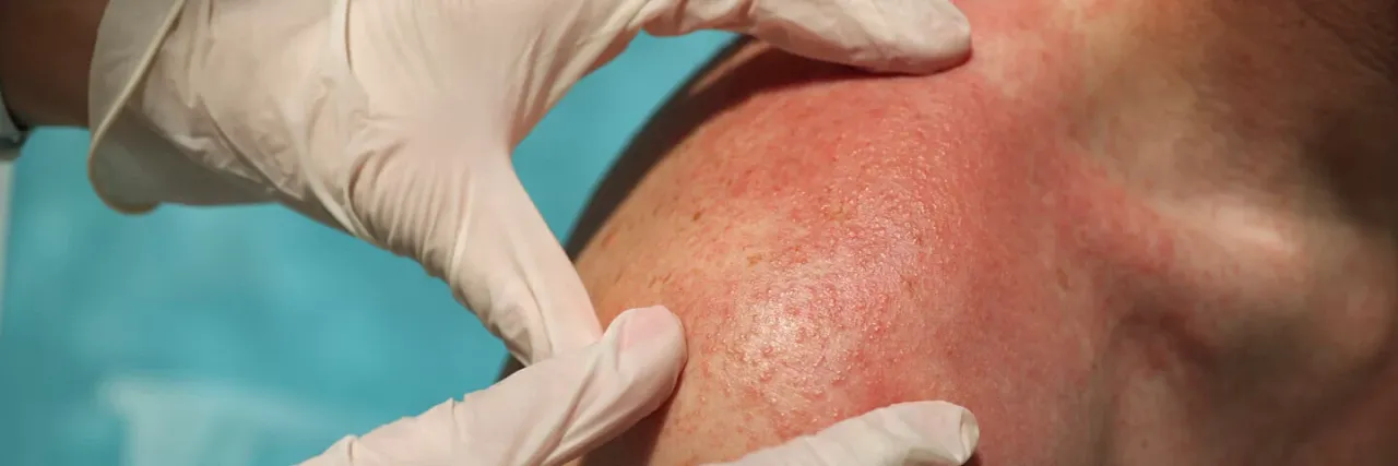 Zdjęcie Lupus Symptome: Erkennen Sie die alarmierenden Anzeichen rechtzeitig