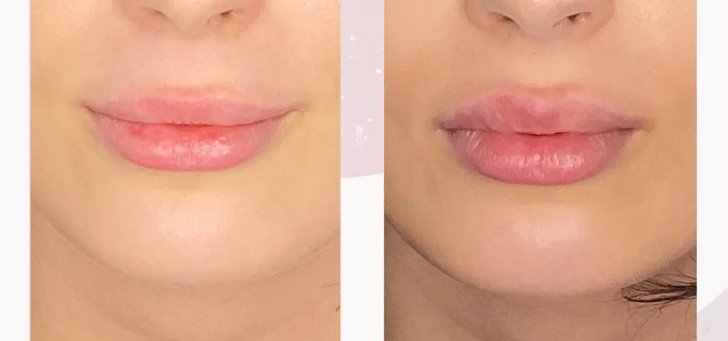 Zdjęcie Ile kosztuje botox ust? Sprawdź ceny i co wpływa na koszty