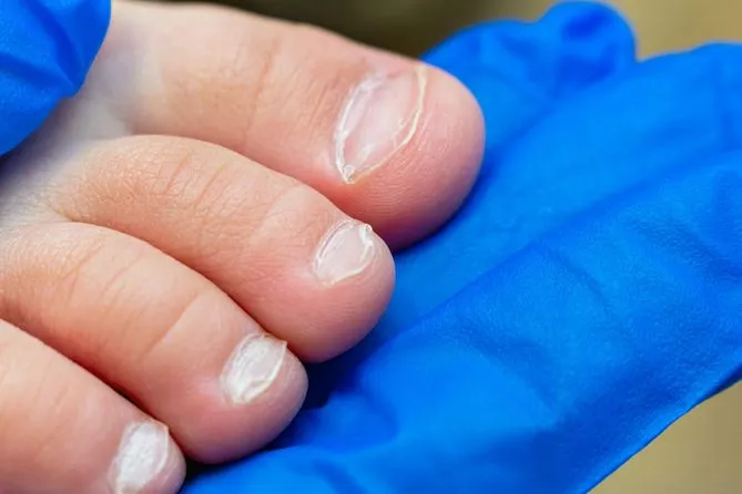 Zdjęcie Wrastający paznokieć u niemowlaka: 7 skutecznych metod leczenia