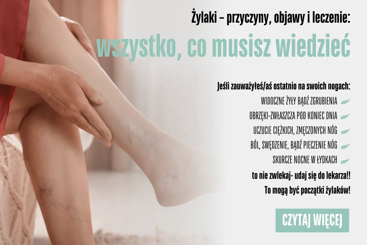Zdjęcie Jak zapobiec żylakom: skuteczne metody i praktyczne porady na co dzień