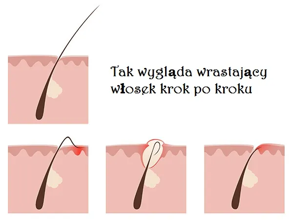 Zdjęcie Golenie pod włos czy z włosem: uniknij podrażnień i wybierz mądrze