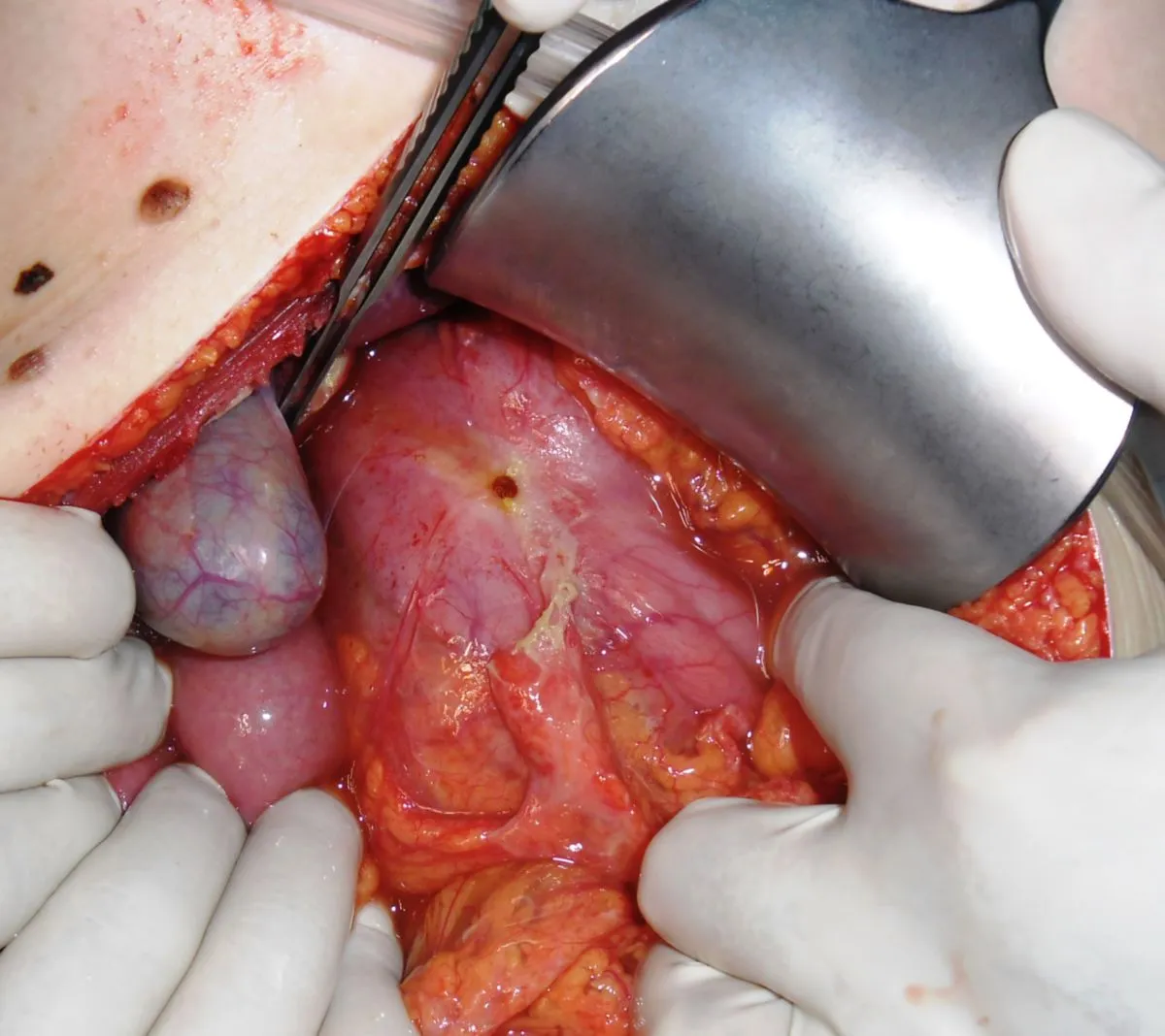 Zdjęcie Ulcus duodeni diagnostik: Wichtige Methoden zur Früherkennung von Geschwüren