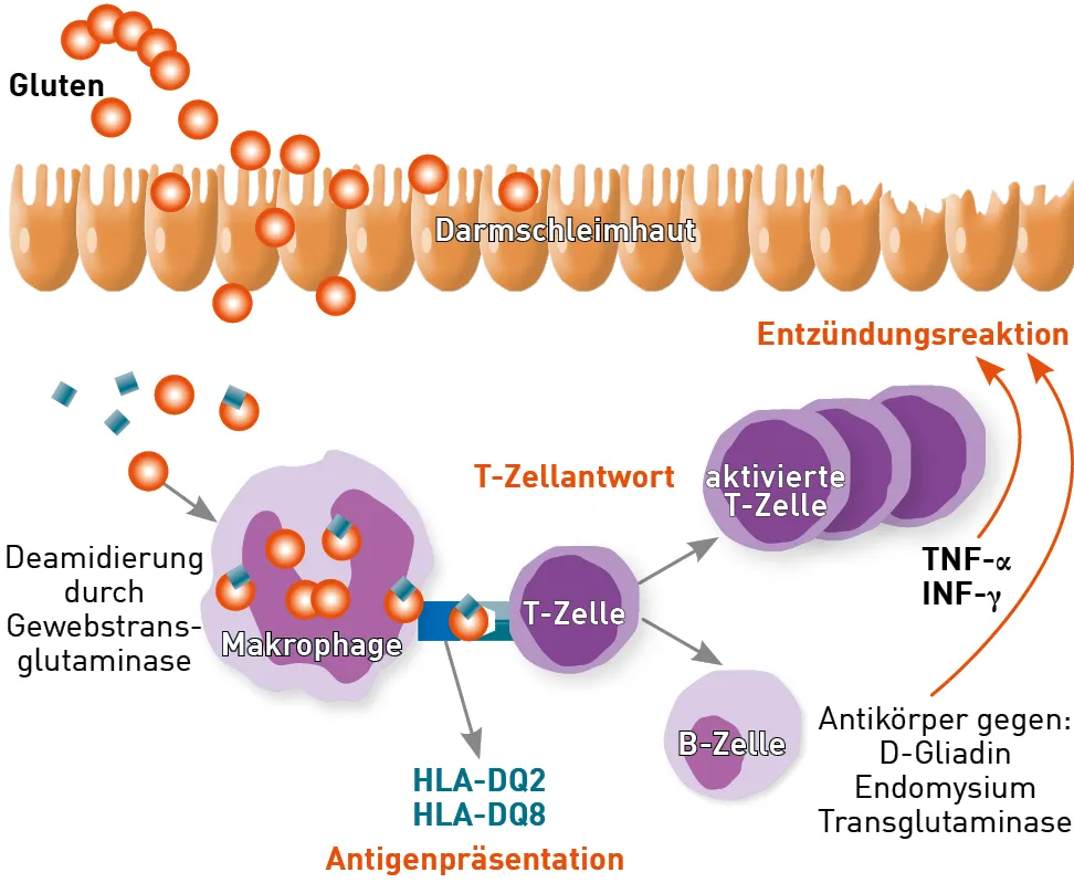 Zdjęcie Zöliakie Diagnostik: Wichtige Schritte zur sicheren Diagnose verstehen