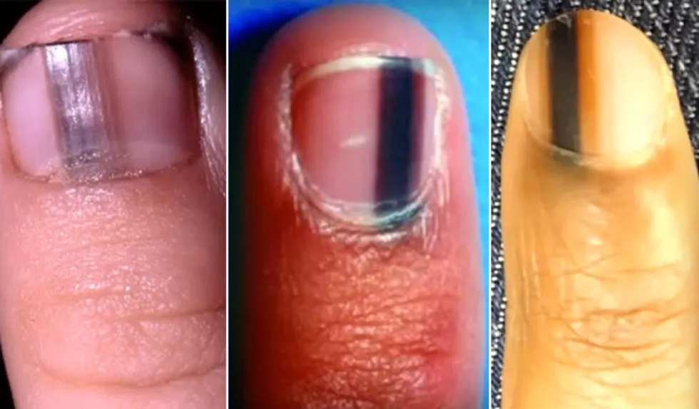 Zdjęcie Czarne kreski pod paznokciami jak drzazgi – co mogą oznaczać?