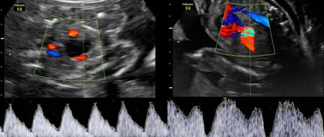 Zdjęcie USG kiedy wynaleziono - fascynująca historia ultrasonografii w medycynie