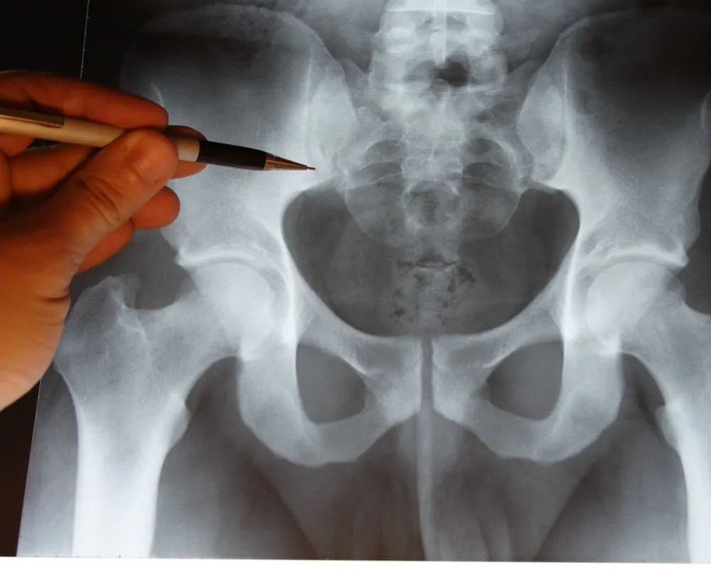 Zdjęcie Powikłania po złamaniu kości udowej: ryzyko i zapobieganie