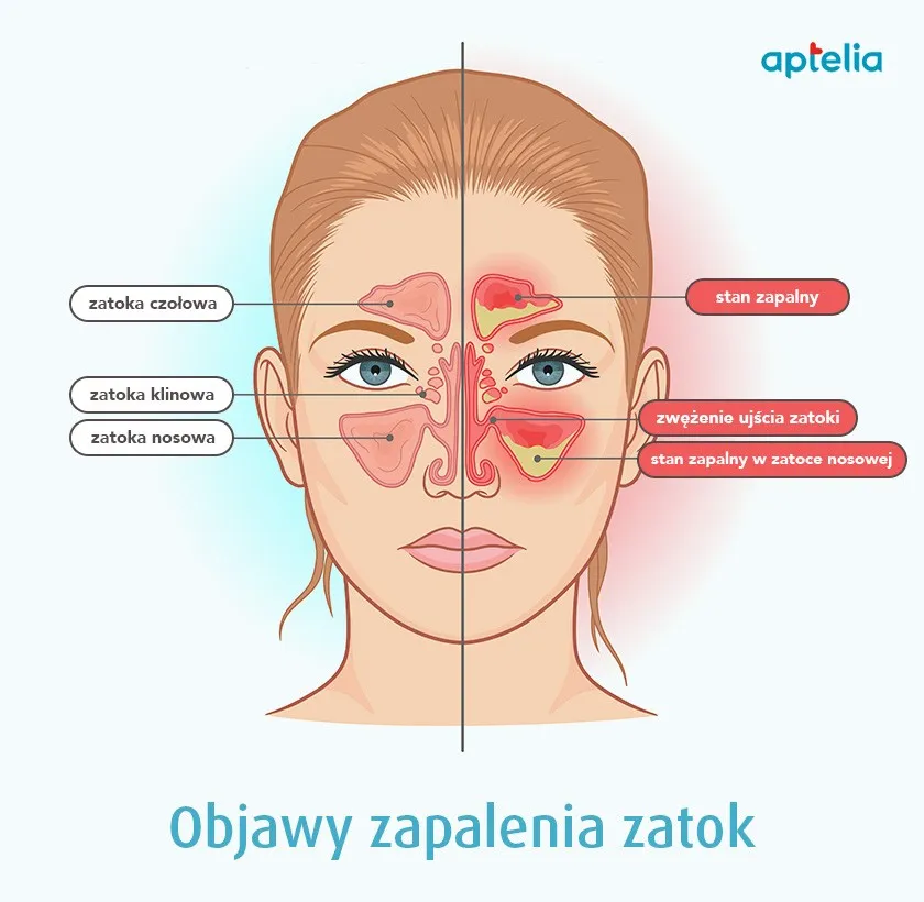 Zdjęcie Skuteczne leki na zatoki - rodzaje, działanie i zalecenia dotyczące stosowania