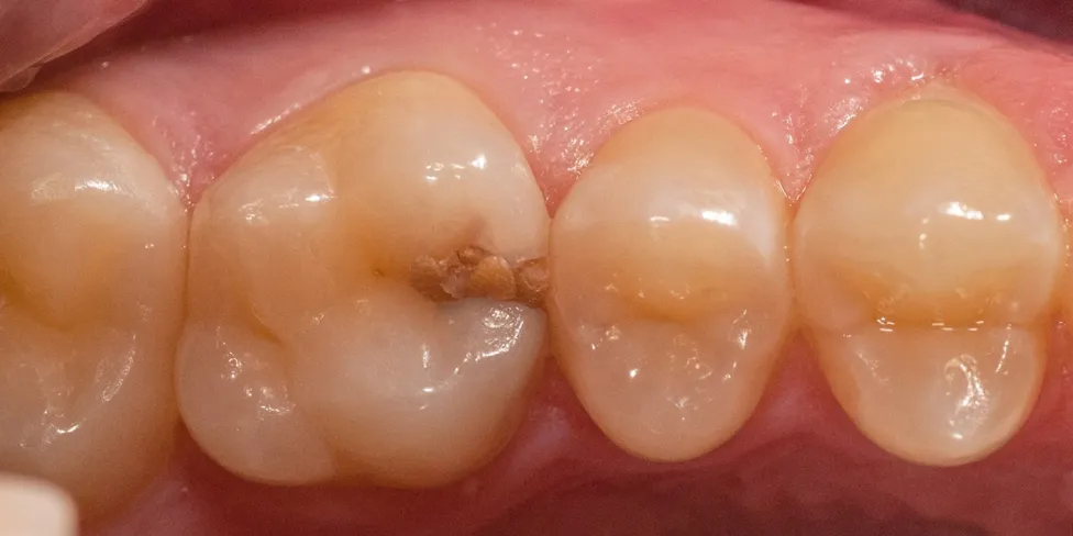 Zdjęcie Jak bezpiecznie zatkać dziurę w zębie? Tymczasowe sposoby na ulgę przed dentystą