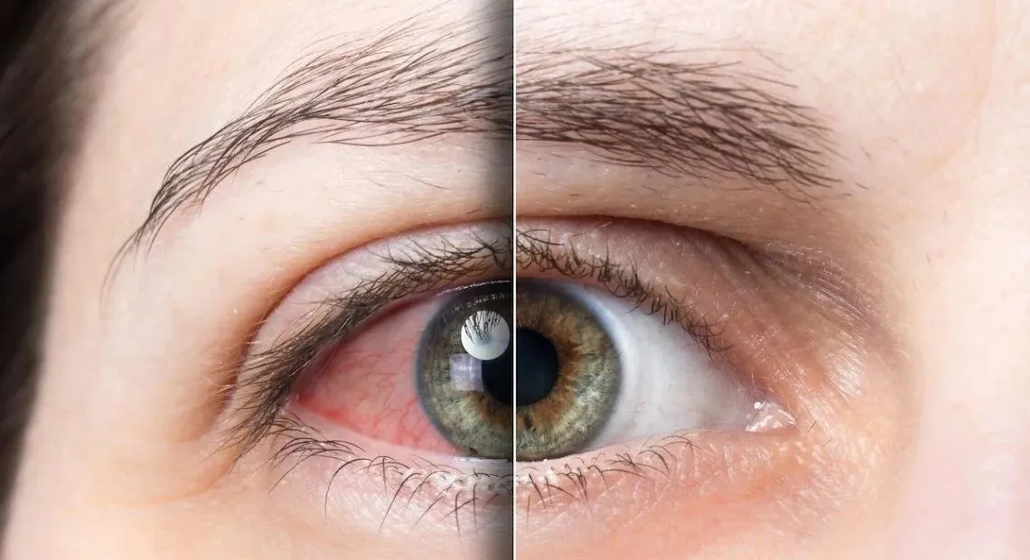 Zdjęcie Jak sprawdzić czy mam jaskrę i uniknąć utraty wzroku