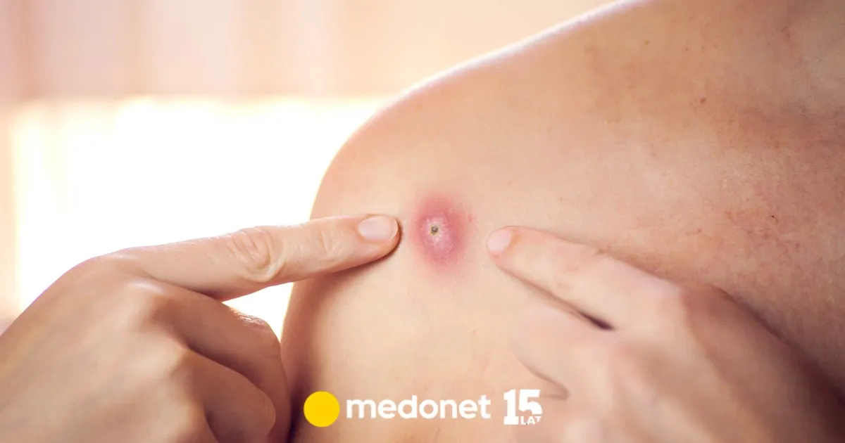Zdjęcie Czyrak czy pryszcz? Kluczowe różnice, objawy i skuteczne leczenie
