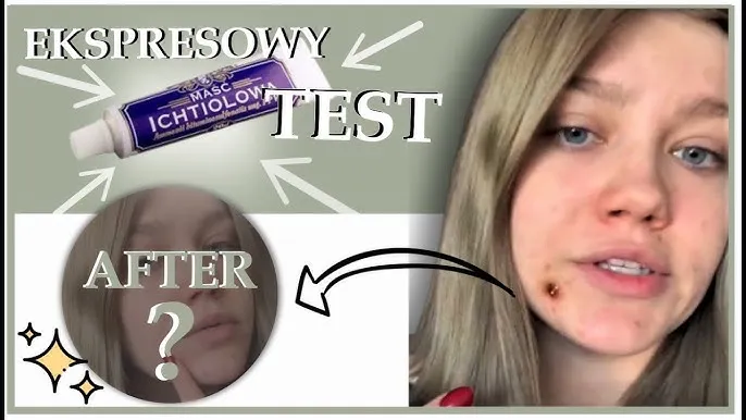 Zdjęcie Czy maść ichtiolowa naprawdę pomaga na pryszcze? Odkryj skuteczność
