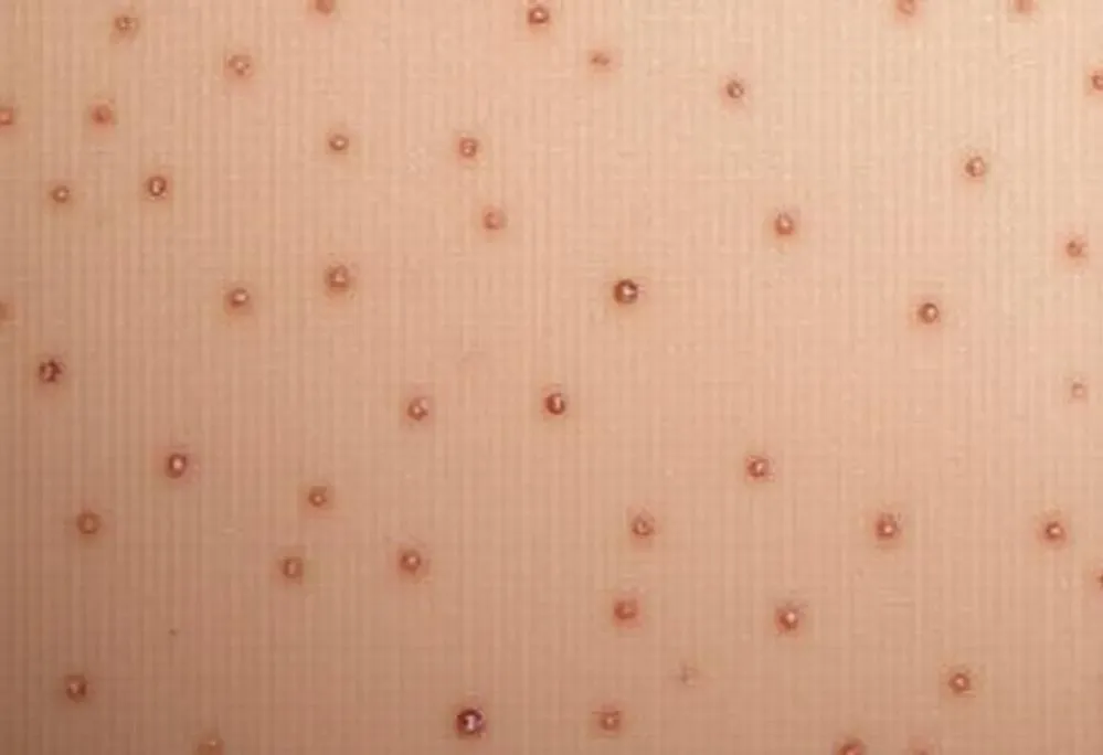 Zdjęcie Grudki po kwasie hialuronowym: kiedy znikną i co robić?