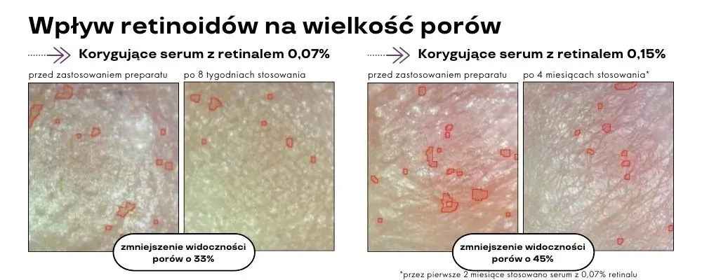 Zdjęcie Retinol lek na co? Odkryj jego skutki i zastosowania w terapii skóry