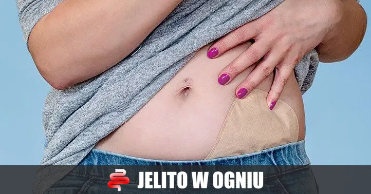 Zdjęcie Wzdęcia przy stomii - jak sobie radzić? Skuteczne sposoby