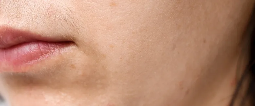 Zdjęcie Skuteczne sposoby na obniżenie testosteronu u kobiet i ich wpływ