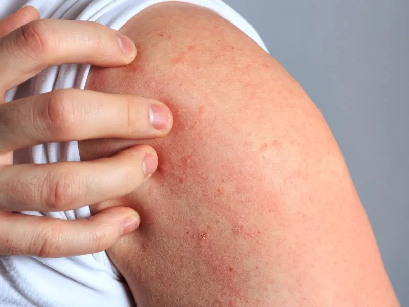 Zdjęcie Alergia na białko mleka krowiego objawy – jak je rozpoznać i unikać?