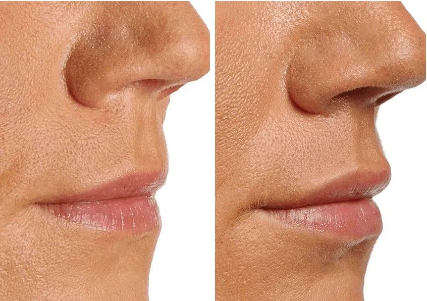 Zdjęcie Powiększanie ust Kraków - gdzie najlepiej zrobić zabieg i nie przepłacić