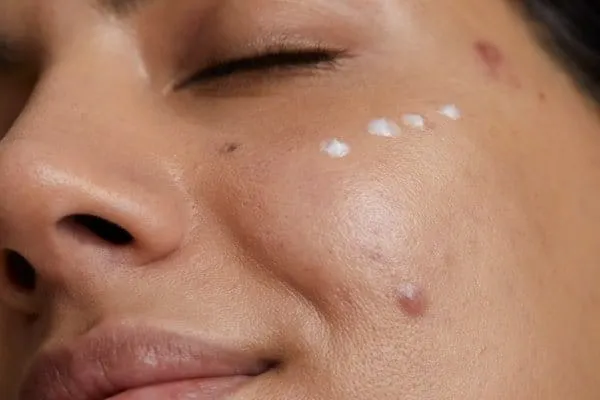 Zdjęcie Pryszcz podsk&oacute;rny: Skuteczne sposoby na b&oacute;l i pozbycie się go