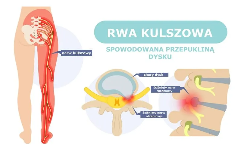 Zdjęcie Przyczyny rwy kulszowej: co może wywołać ten bolesny stan?