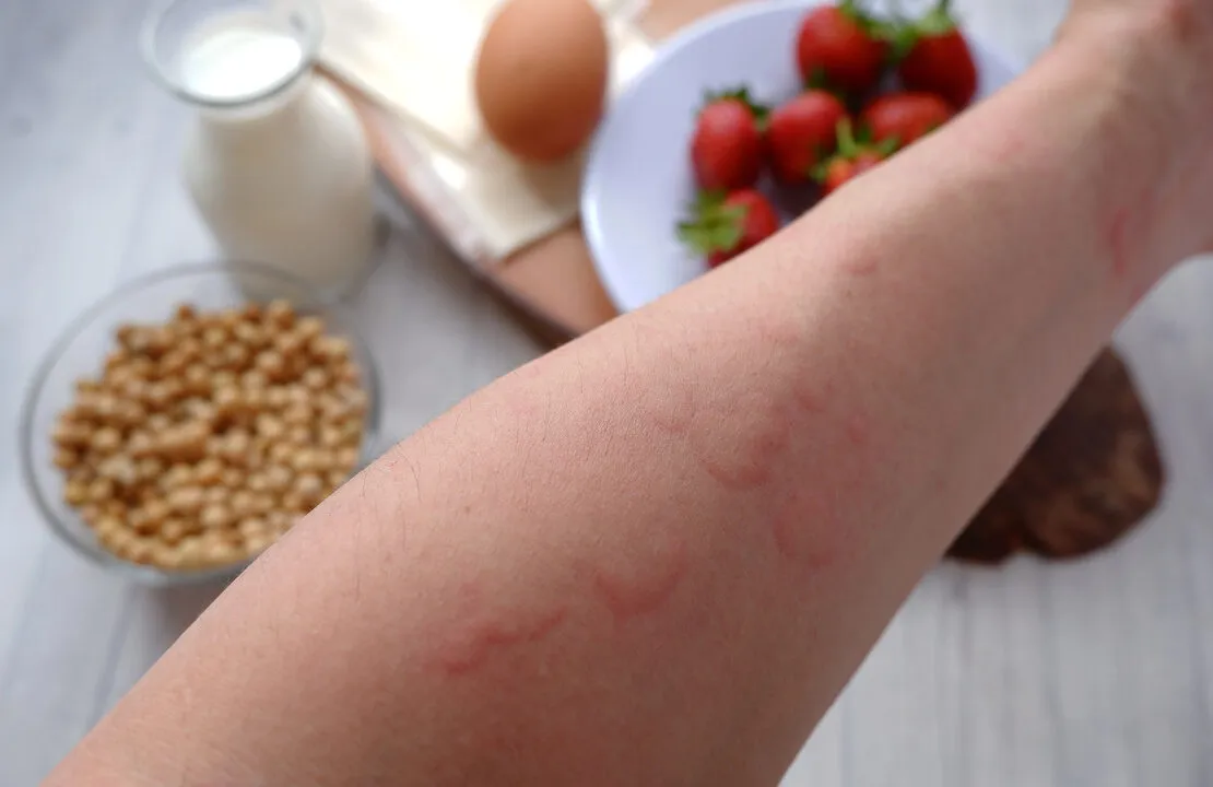 Zdjęcie Alergia na truskawki: objawy, reakcje krzyżowe i co robić