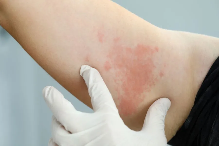 Zdjęcie Alergia na sierść psa u dzieci - objawy, które mogą zaskoczyć rodziców