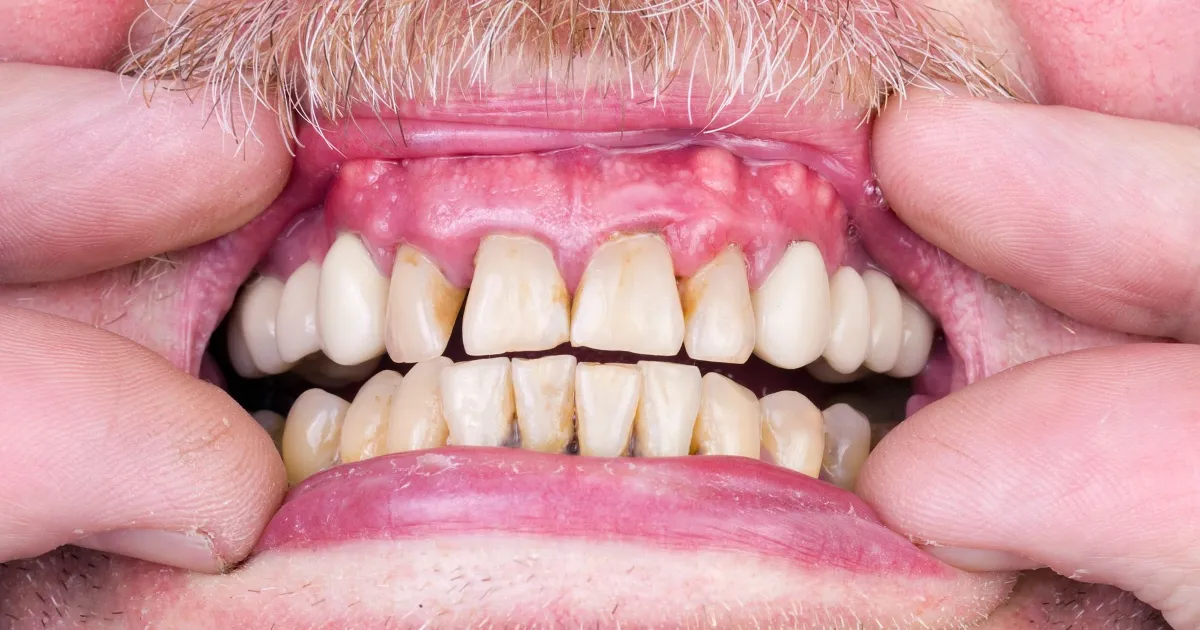 Zdjęcie Skuteczne sposoby na stan zapalny dziąseł, które przyniosą ulgę