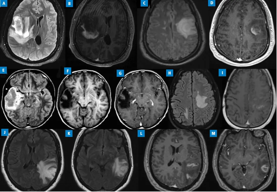 Zdjęcie Jak odróżnić nerwicę od guza mózgu i uniknąć błędnej diagnozy