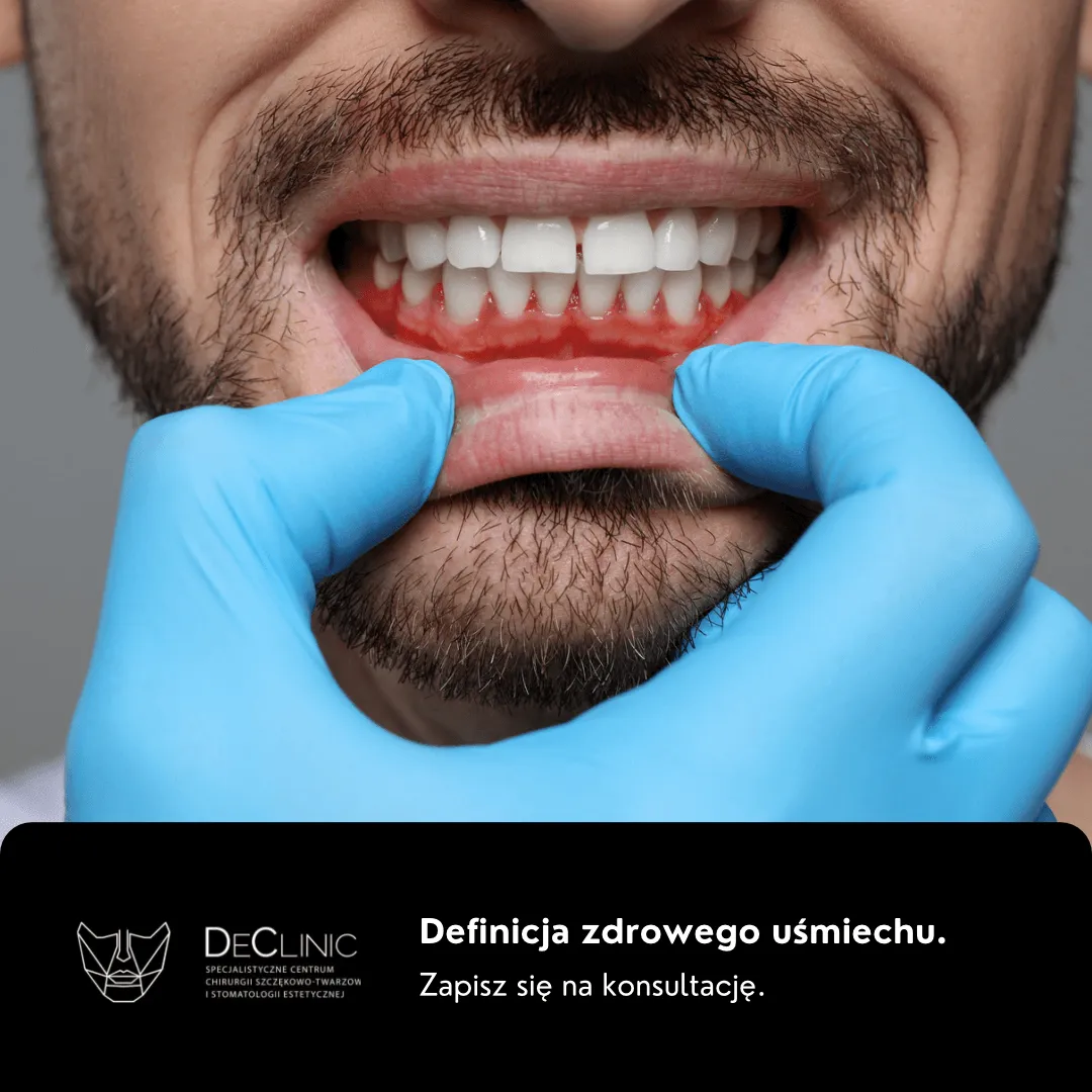 Zdjęcie Jak wygląda zapalenie dziąseł? Objawy, które mogą Cię zaskoczyć
