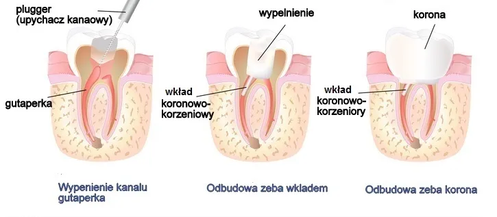 Zdjęcie Czy ból zęba zawsze oznacza leczenie kanałowe? Oto prawda o bólu zębów