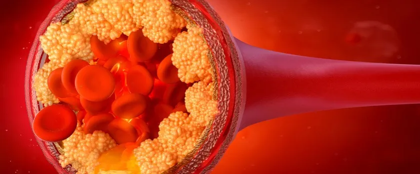 Zdjęcie Jak obniżyć cholesterol u dziecka - skuteczne metody i porady