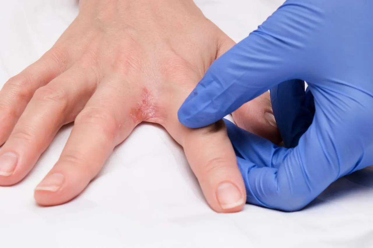 Zdjęcie Skuteczne sposoby na potnicę bez recepty, które przynoszą ulgę