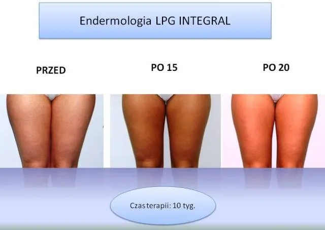 Zdjęcie Endermologia czy działa? Sprawdź skuteczność i efekty zabiegu