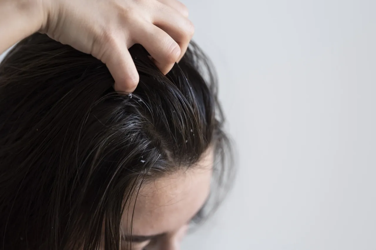 Zdjęcie Jak stosować peeling do włosów, aby uniknąć problemów ze skórą głowy
