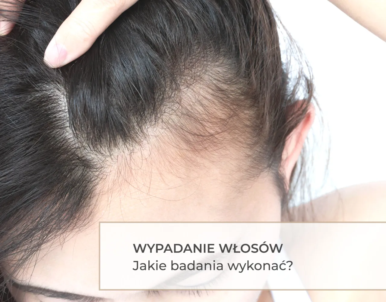 Zdjęcie Wypadanie włosów jakie badania? Sprawdź, co może je powodować