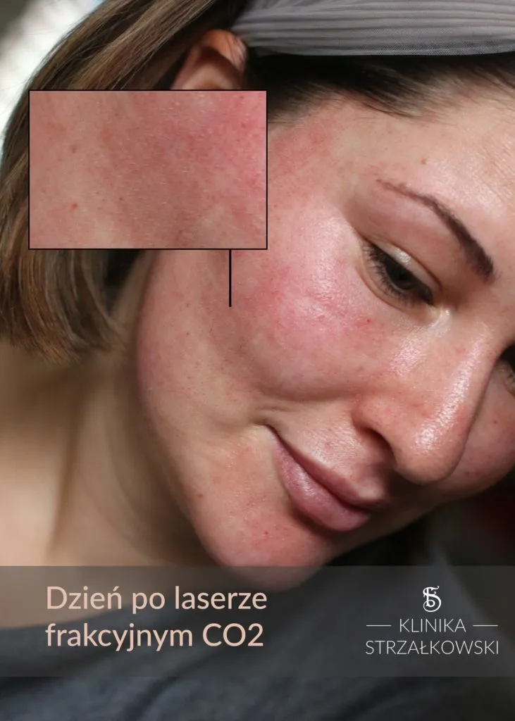 Zdjęcie Czy po laserze frakcyjnym można się malować? Ważne zasady pielęgnacji