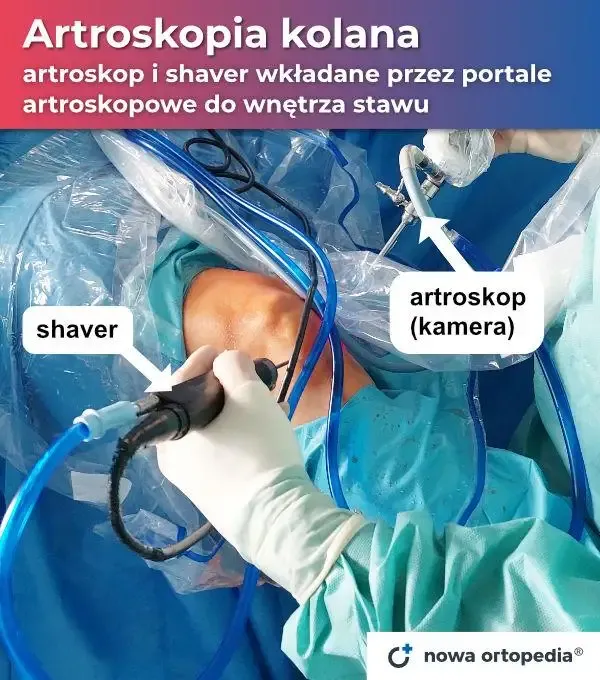 Zdjęcie Ile się czeka na artroskopię kolana w NFZ? Czas oczekiwania zaskakuje